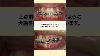 八重歯・ガチャ歯の歯列矯正│矯正歯科│braces