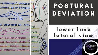 POSTURAL DEVIATION LATERAL VIEW LOWERE LIMB (Posture Biomechanics)Physiotherapy Tutorial