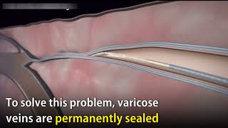 Treating Varicose Veins !! Check out how varicose veins are treated.#veintreated