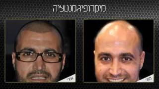 מיקרופגמנטציה לגברים הדמיית שיער לגבר תל אביב חיפה