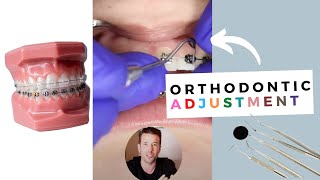 Orthodontic Adjustment | Braces Colors #shorts