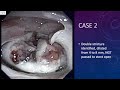 ATECh: Electrocautery Incisional Therapy (EIT) for esophageal stricture