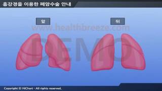 [시연용] c0067abko 축약판 흉강경을 이용한 폐암수술 안내