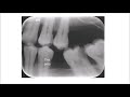 Cementum (Root Caries)