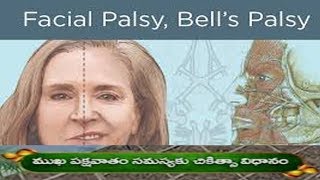 ముఖ పక్షవాతం సమస్యకు చికిత్సా విధానం : Ayurvedic Treatment, Herbal Remedies for Bell's Palsy