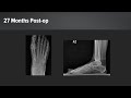 Hallux Rigidus Treatment With ArthroFLEX® Dermal Allograft