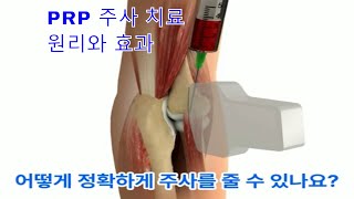 PRP 주사로 팔꿈치 통증 해결: 테니스 엘보우와 골퍼 엘보우 치료 가이드