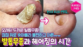 오래된 두꺼운 발톱무좀! 이젠 점점 위로 솟아올라 더 불편하고 아파하셨는데... 발톱무좀과 이제 헤어질 시간이예요♥ #내성발톱 #무좀발톱 #발톱 #제거 ​#레푸스