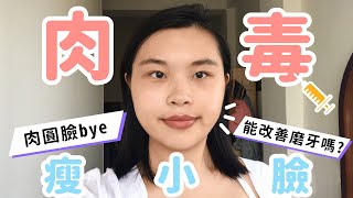 【肉圓臉ByeBye！肉毒咀嚼肌/瘦小臉 施打過程分享全紀錄】