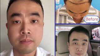 髮際線高怎麼辦前額髮際線無痕種植，術後心得分享Yonghe hair transplant