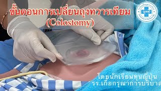 ขั้นตอนการเปลี่ยนถุงทวารเทียม (Colostomy)