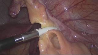 Laparoscopic Exploration - Appendectomy