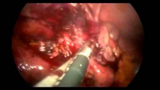 “Low cost” Single incision laparoscopic appendicectomy 2/2