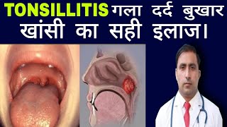 TONSILLITIS गला दर्द बुखार खांसी का सही इलाज। || Dr Kumar education clinic