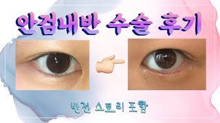 안검내반이라 쓰고 돈버리기 라고 읽는다 | 속눈썹 찌르는 눈 수술 후기