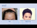 珠海美人尖植髮種植，無痕加密技術1130單位案例展示！yonghe hair transplant