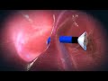 v wave® ventura® interatrial shunt procedure