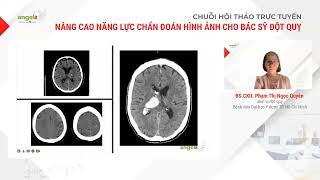 3 Ứng dụng chẩn đoán hình ảnh trong điều trị đột quỵ não (BS.CK2. Phạm Thị Ngọc Quyên)