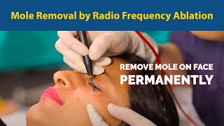 Mole Removal by Radio Frequency Ablation| Remove mole on face permanently  | Dr. Jyoti Gupta MD