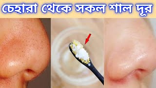 Blackheads এবং  Whiteheads গোঁড়া থেকে তুলে ফেলুন মাত্র ৩ মিনিটে/সকল কালো শাল দূর করার উপায়