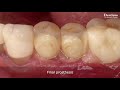 immediate implant placement following minimally invasive extraction and gap filling