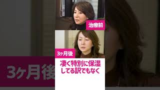 整形しないアンチエイジング美容医療「肌の再生医療」ビフォーアフター｜54歳 女性｜3ヶ月検診#shorts