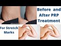 PRP Treatment for Stretch Marks | Skin Care | Dr Saurabh Shah