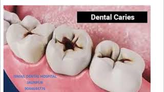 DENTAL CARIES (दांतो की सड़न/दांतों में कीड़ा लगना)