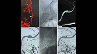 59y/F with headache had ruptured distal ACA (DACA) aneurysm