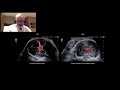 Low Velocity Blood Flow Detection (DFI) in Fetal Medicine - Clinical Cases with Dr. Marc Althuser