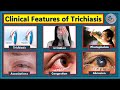 Trichiasis- What are the Symptoms & Signs of Trichiasis.