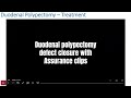 duodenal polypectomy closure with the assurance™ clip