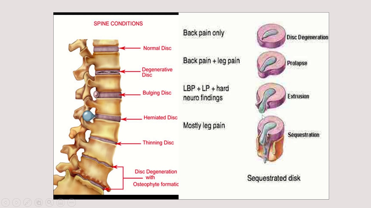 Hernia Nukleus Pulposus (HNP) - YouTube