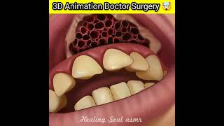 3D Animation Doctor infection surgery 🤯 ? #shorts #viral