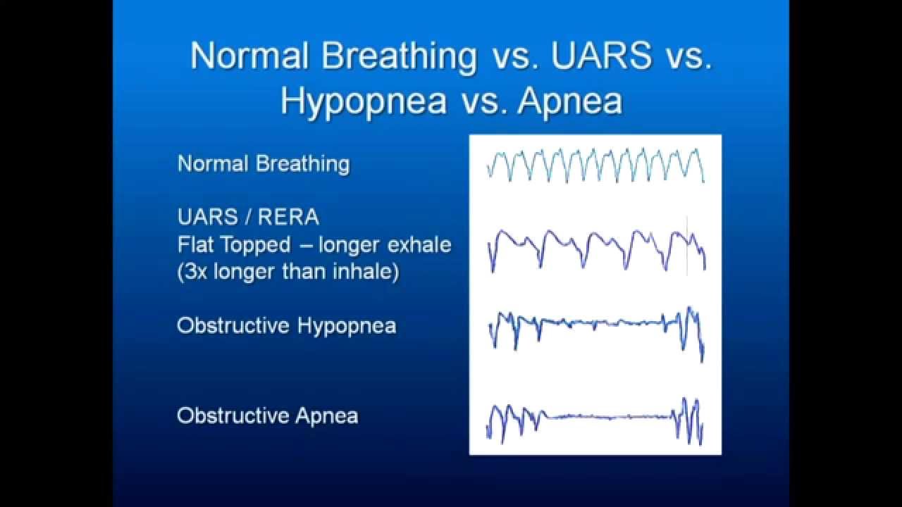 Obstructive Sleep Apnea Part 8: Evaluation & Dentistry's Role - YouTube