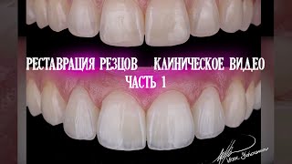 Реставрация фронтальных зубов. Клиническое видео. Часть 1