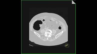 Virtual colonoscopy with cancer in transverse colon 2