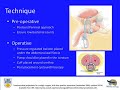 Artificial Urinary Sphincter after 40 Years of Use: Indications, Techniques and Outcomes