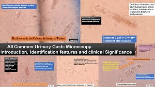 All common urinary casts: Introduction, Identification tips and clinical significance