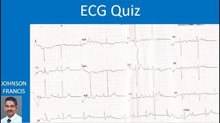 ECG Quiz