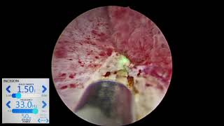 Thulium Fiber Laser Enbloc resection of Bladder Tumour