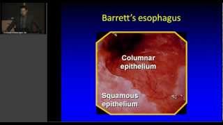 Controversies in the management of Barrett's Esophagus