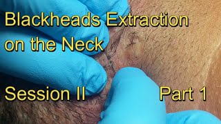 Blackheads Extraction on the Neck - Session II - Part 1