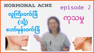 hormonal acneဟော်မုန်းဝက်ခြံ episode 2 ကုသမှုအပိုင်းပါ