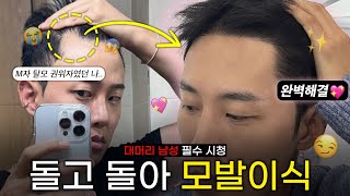 30대... 이제는 머리숱 싸움입니다 | 남자 M자 탈모 비절개 모발이식 1년 차 후기