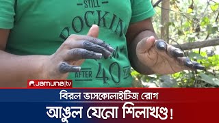 হাতের আঙুল হয়ে গেছে শিলাখণ্ড! বিরল রোগে আক্রান্ত নুরুল! | Stone_Disease