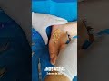 Botfly Maggot Removal #spa #doctor #satisfying #pimple #removal