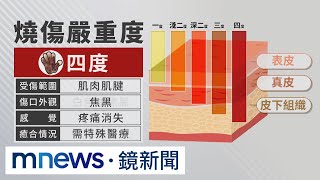 台中女遭潑熱湯無痛感？　醫師：恐深二度燙傷｜#鏡新聞