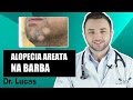 Alopecia Areata na Barba (Falhas Grandes na Barba) - Dr Lucas Fustinoni