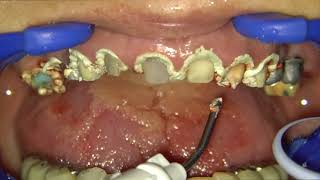 Stopping the bleeding after intraoral sandblasting with Access Edge.